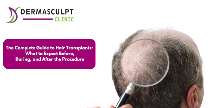 The Complete Guide to Hair Transplants: What to Expect Before, During, and After the Procedure