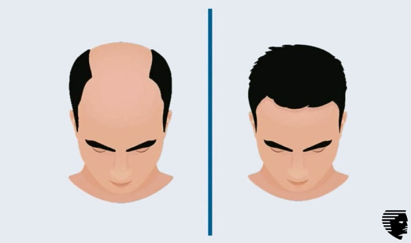 hair-transplant-bangalore