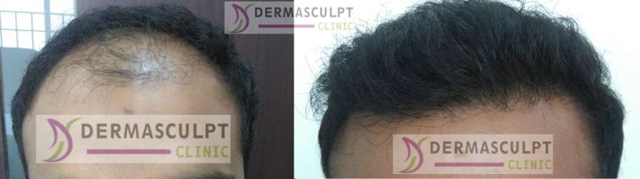 hair transplant bangalore