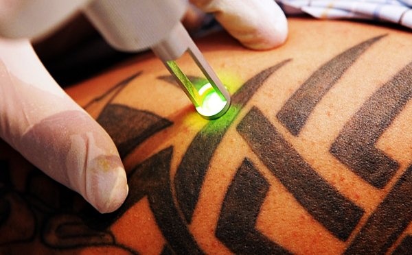 laser-tattoo-removal